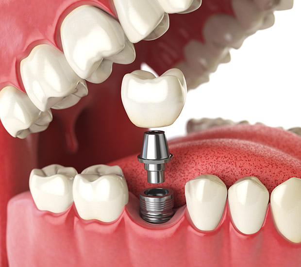 Middleburg Will I Need a Bone Graft for Dental Implants