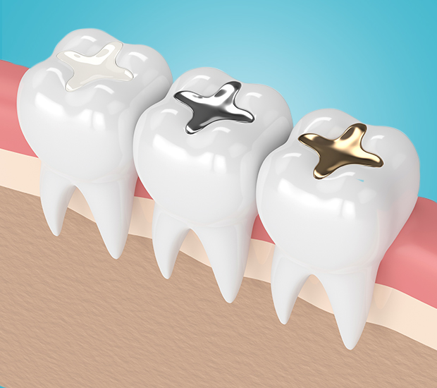 Middleburg Composite Fillings