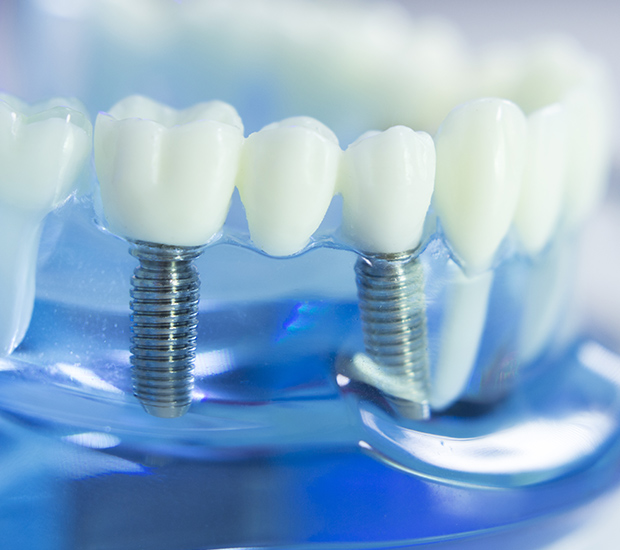 Middleburg Dental Implants