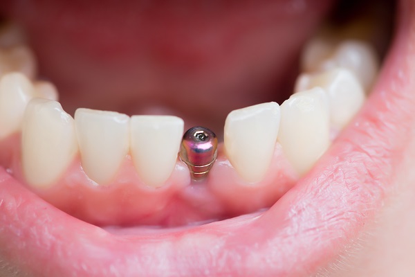 Implant Dentist Middleburg, FL