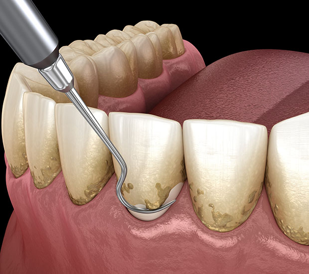 Middleburg Root Scaling and Planing